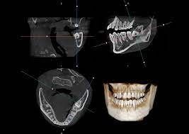 OPG-X-Ray-1